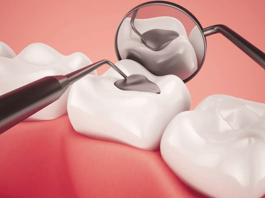 پر کردن دندان با بیمه تجارت نو