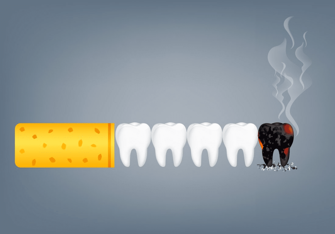 ایمپلنت دندان در افراد سیگاری
