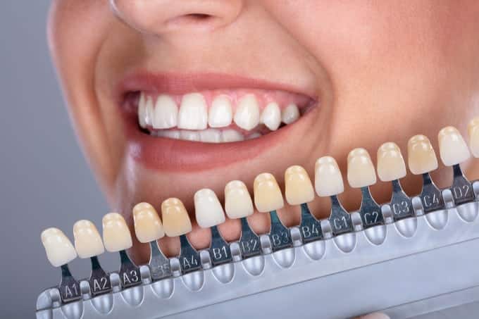 لحاظ کردن رنگ پوست در کامپوزیت دندان
