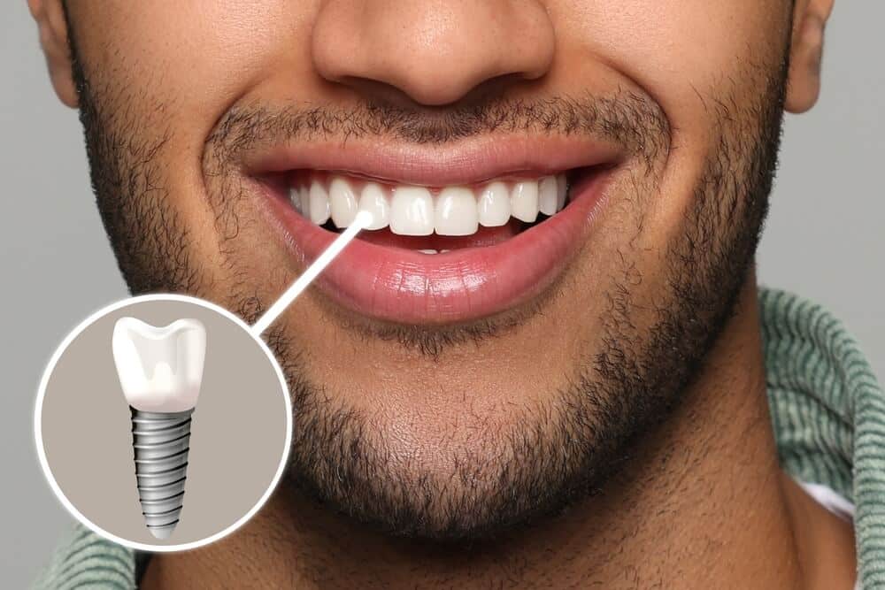 مرکز ایمپلنت دندان